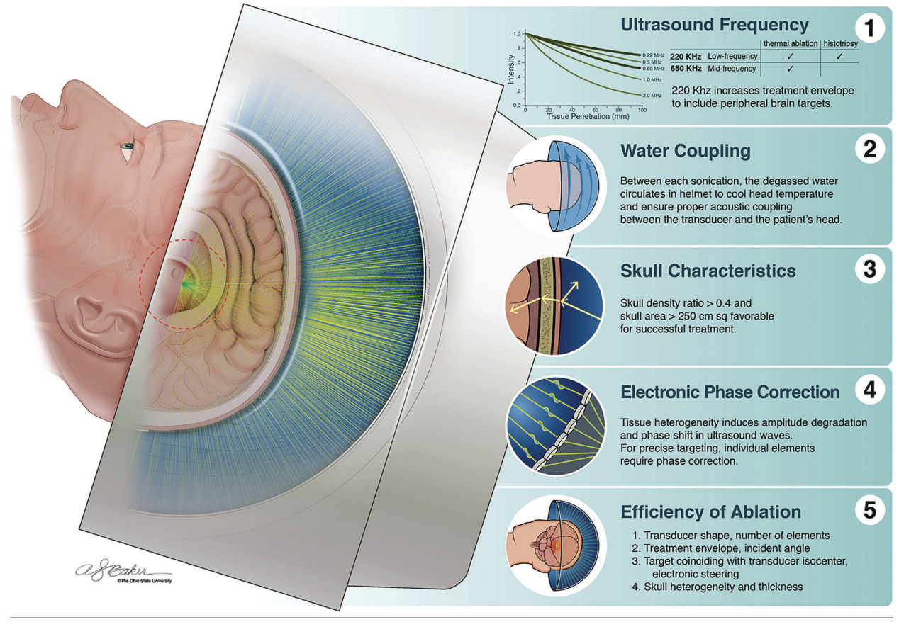 健康・医学 Focused Ultrasound Techniques What is all the 'FUS' about with focused ultrasound for